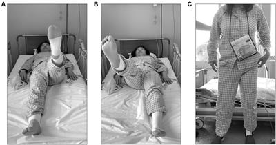 Case report: Physical findings, physical therapy practice, and characteristics of disability of activities of daily living caused by obturator nerve palsy after neurotmesis